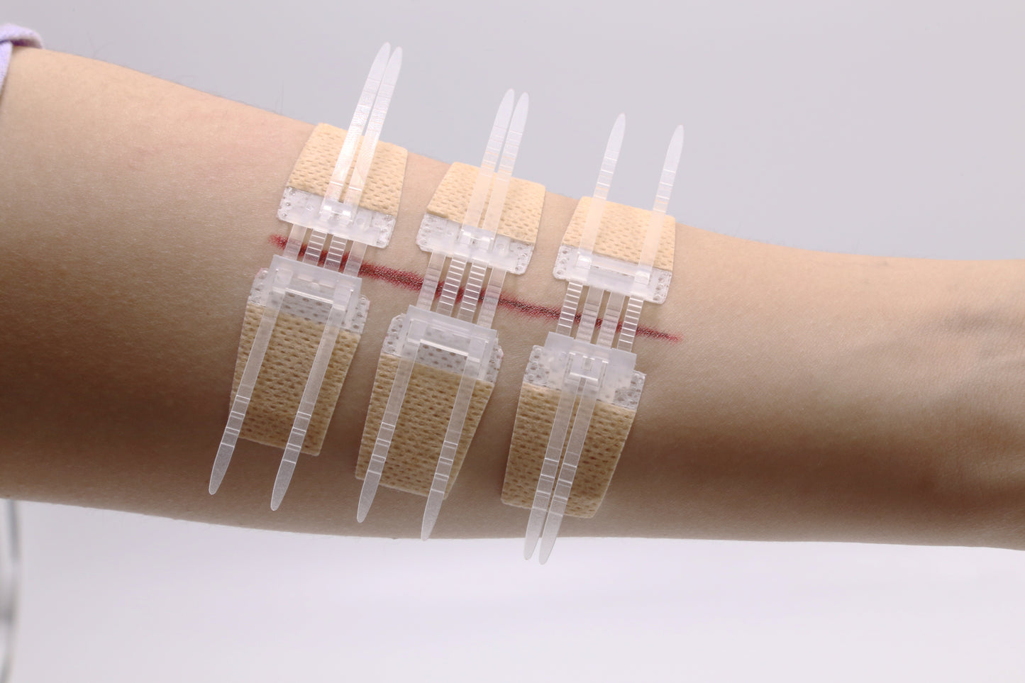 QuickStitch™ Hechtpleister, Naaldloze Hechting (Nu 5 stuks!)